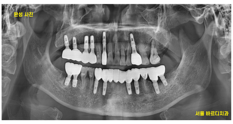 강일동 임플란트 위아래 치아 흔들림과 통증이 있을 때 방법은? 관련 이미지 11