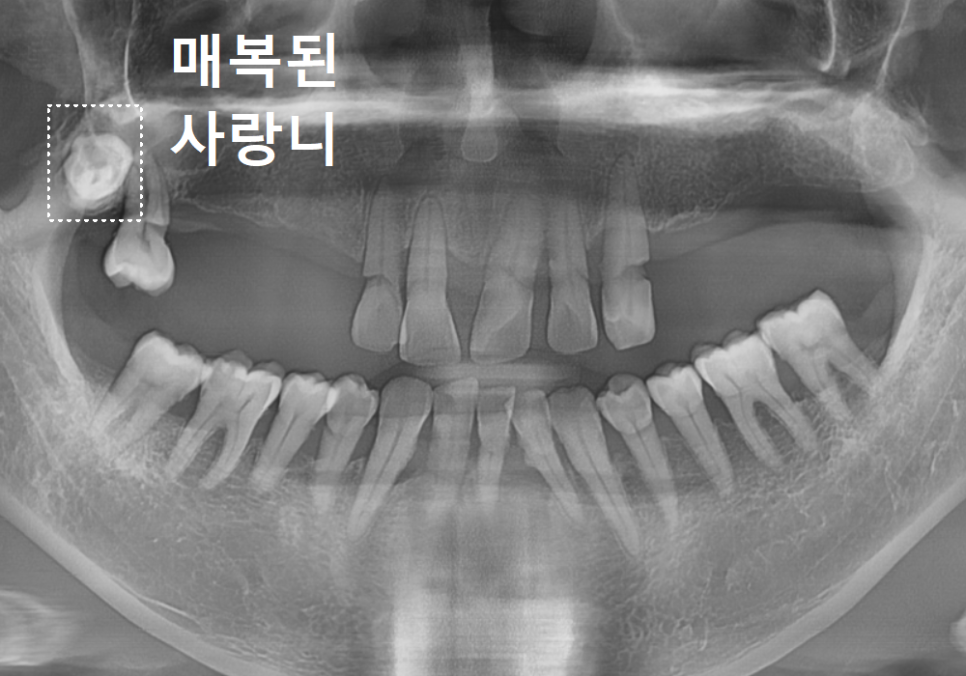 위 턱 전체 임플란트 vs 부분 틀니, 나에게 꼭 필요한 치료법 찾기 관련 이미지 5