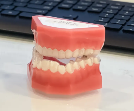 고덕동 치아교정 유지장치는 부정교합 재발을 막기위한 필수입니다! 관련 이미지 8