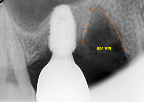 상일동 치과 잇몸 내려감 치료는 임플란트로 관련 이미지 4