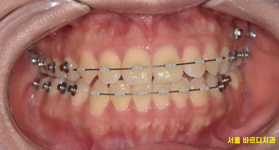 강동구 치아교정 병원에서 물어봐야할 필수 질문 4가지 관련 이미지 2