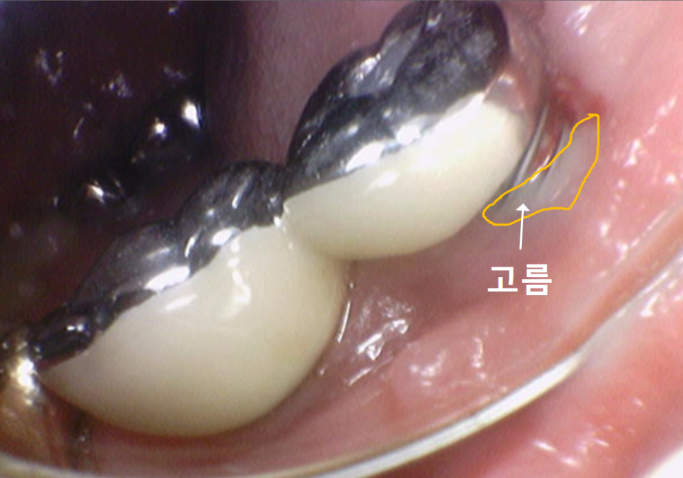 천호동 임플란트 재식립 사례, 평생 쓰는 줄 알았는데? 관련 이미지 4