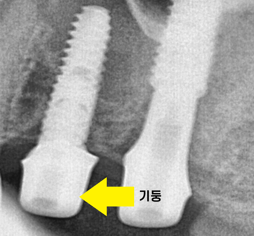 임플란트 2차 수술 과정 아직도 안끝났어요? 죄송합니다!! 관련 이미지 7