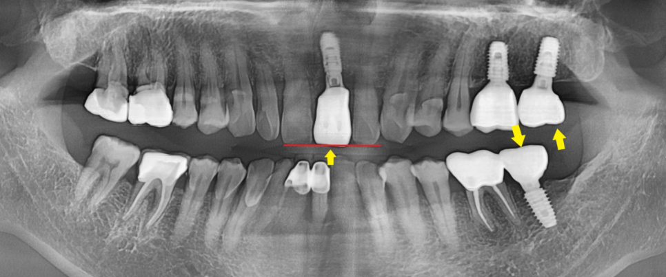상일동치과 서울바르디치과 무절개 네비게이션 임플란트 치료증례 #3 관련 이미지 15