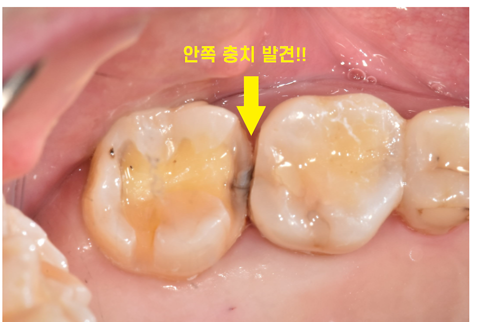 치실 안쓰면 이렇게 됩니다!!  치아 사이 충치 인레이 치료 관련 이미지 7