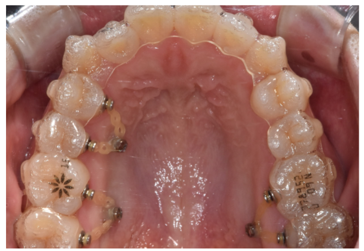 고덕동 치아교정 치아 이동 속도가 느려요 원인은? 관련 이미지 7