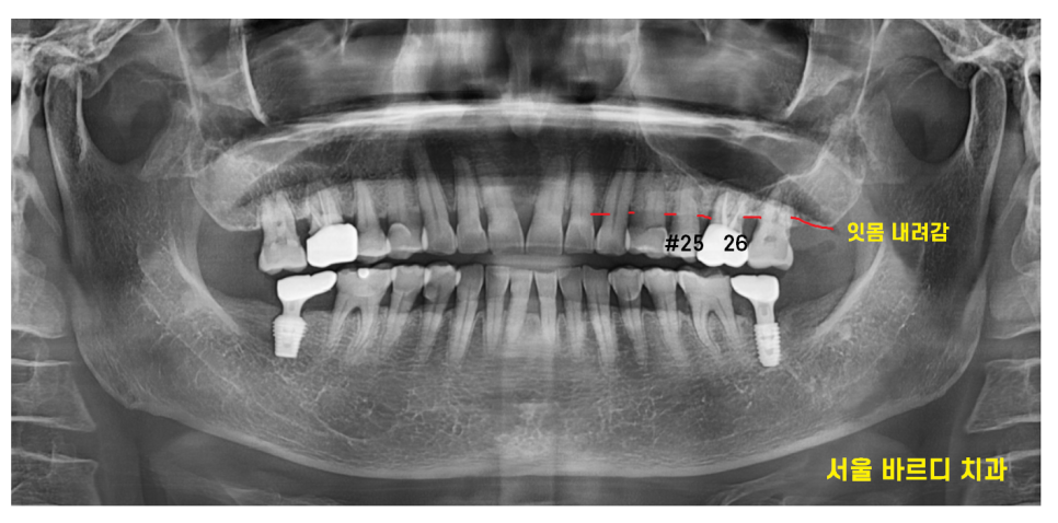 치아 쪼개짐으로 상악동 거상술 동반한 임플란트 수술 관련 이미지 1