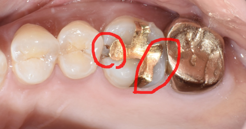 골드 인레이 하방 이차우식 => E.max 인레이로 재치료 케이스 관련 이미지 2