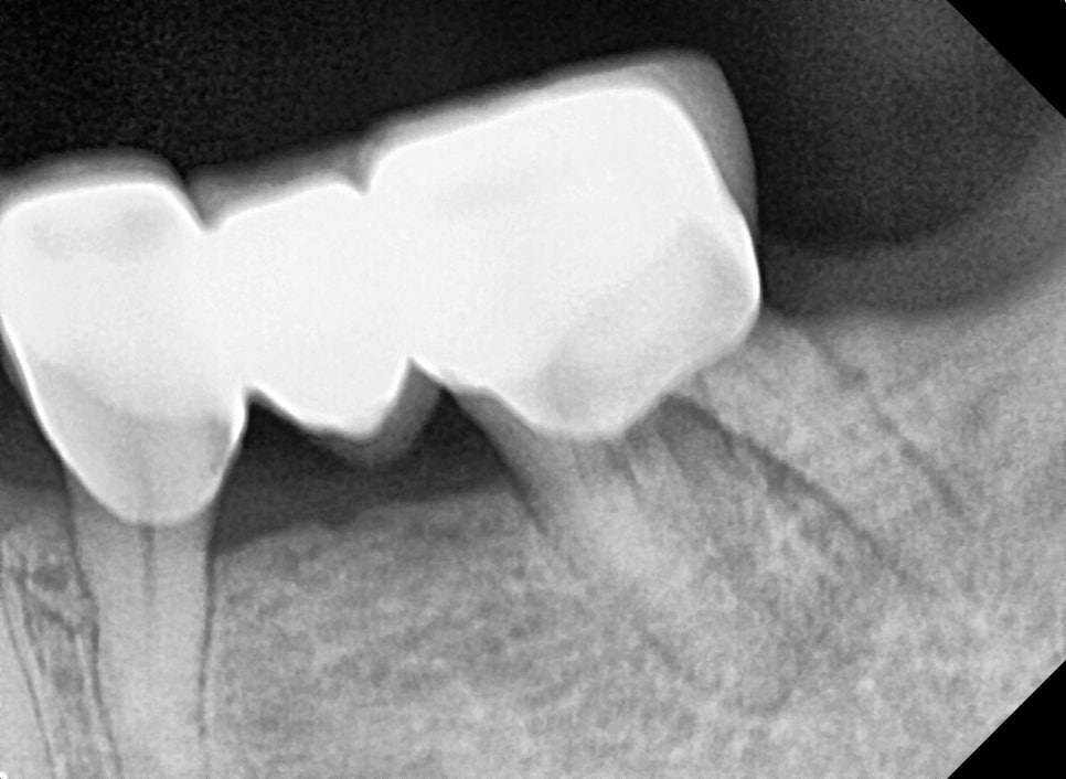 Godok Implant: Treatment That Reduced the Financial Burden with Insurance Implants for a Patient in Their 70s image 5