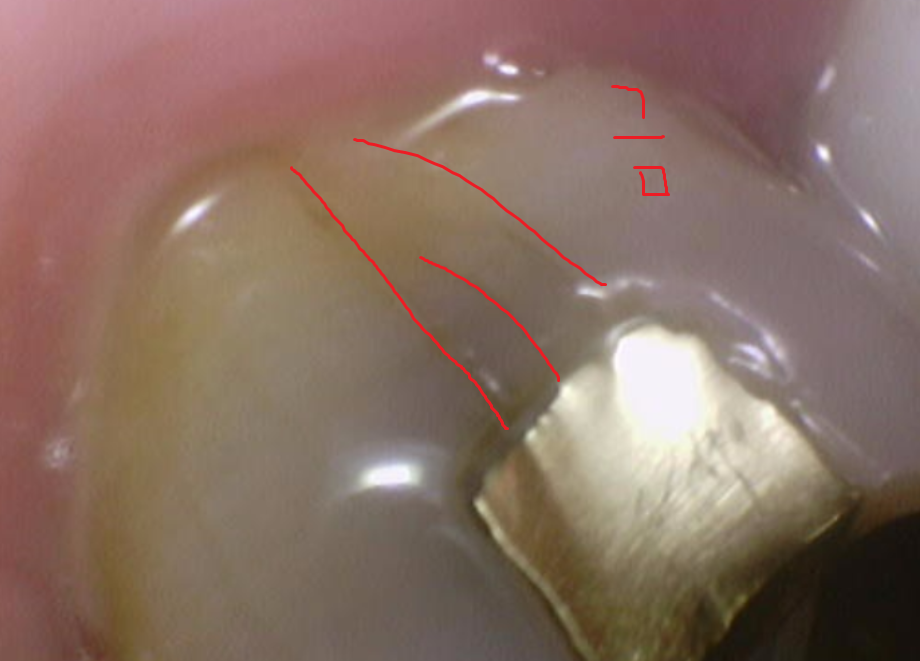 풍산동 치과 골드 인레이 치료했던 치아가 또 충치가 생김. 관련 이미지 8