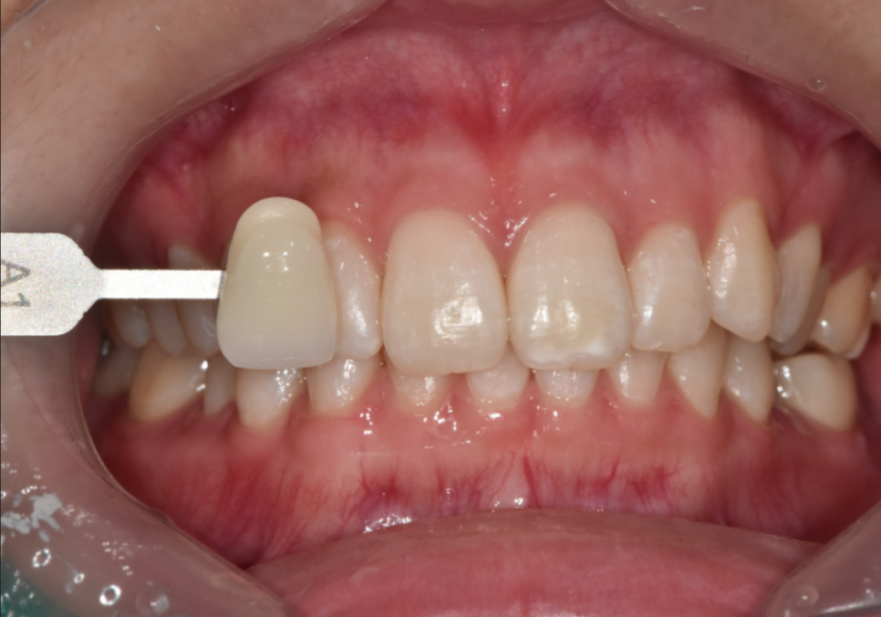 명일동 치과, 미백하면 연예인 치아처럼 새하얘진다는 말, 저는 못하겠습니다. 관련 이미지 13