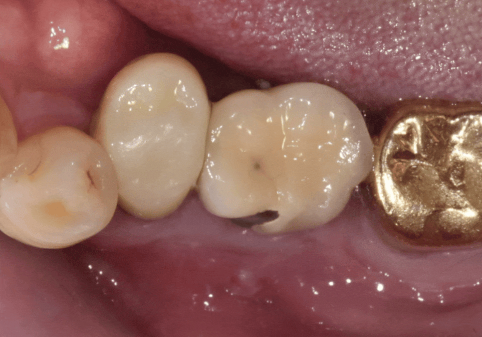 상일역 임플란트, 음식물 끼는 이유, 처음엔 안 그랬는데 왜 점점 심해지는 걸까요? 관련 이미지 6