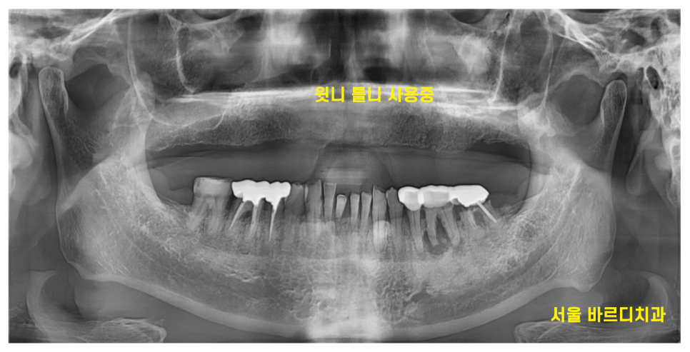 둔촌동 치과 80대 임플란트 가능한가요? 관련 이미지 2