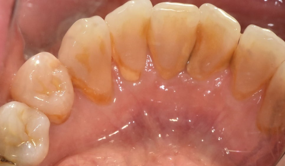 Gangdong-gu Dental Clinic: I Gag So Easily That I’m Too Afraid to Go to the Dentist. Tips to Reduce Gagging image 7