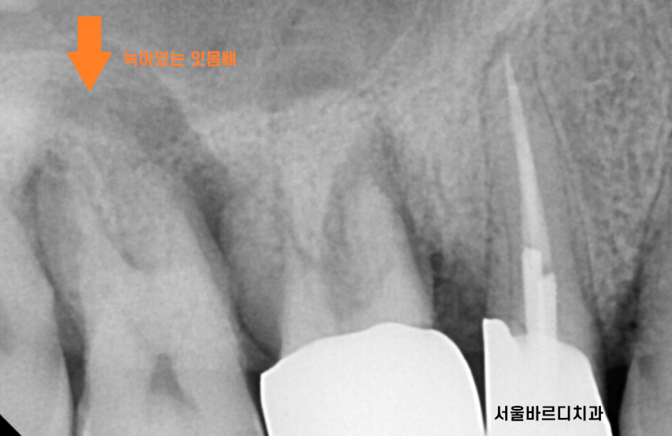 감일동 치과 어금니 시림 충치가 아닐 수도 있다? 임플란트 하게된 사연 관련 이미지 5