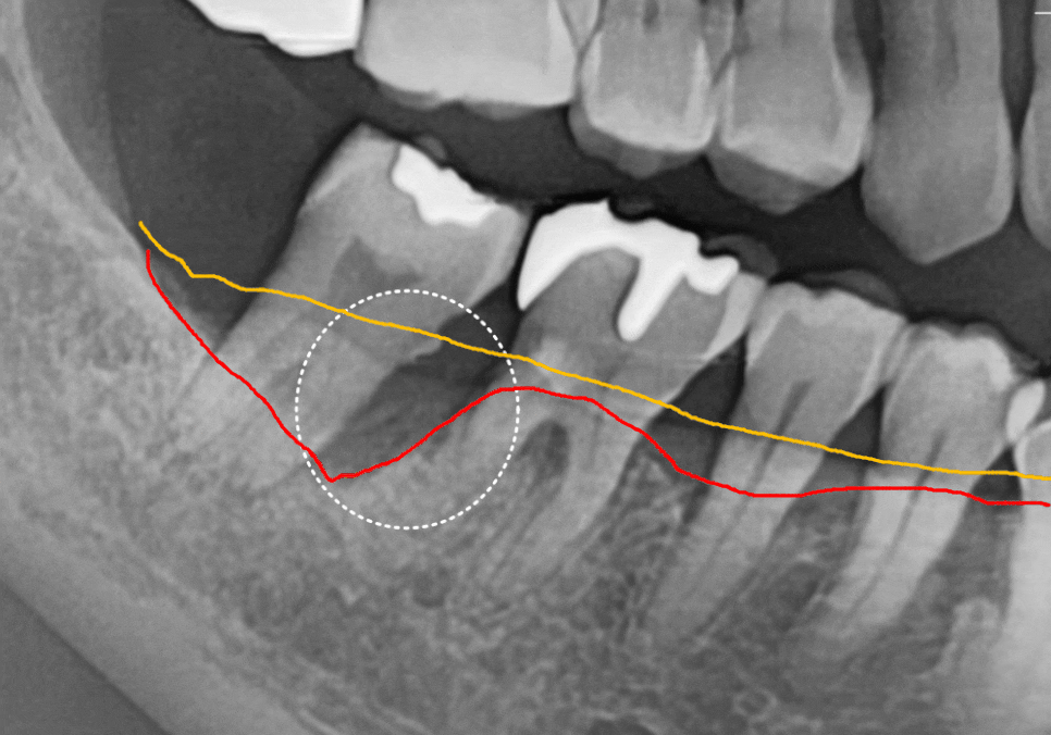 Gangil-dong Molar Implant, "It’s Loose—Can’t You Just Bond It with Resin?" image 8