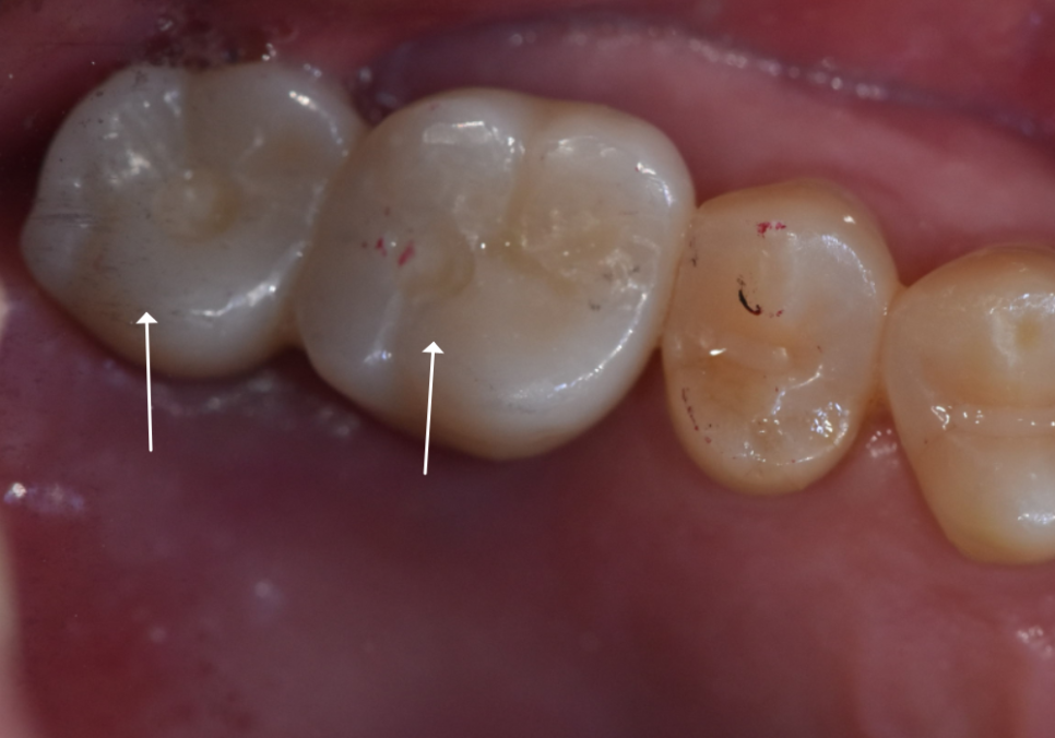 상악동 거상술 부작용 걱정되시나요? 재수술 없는 뼈이식의 정석 공개 관련 이미지 15
