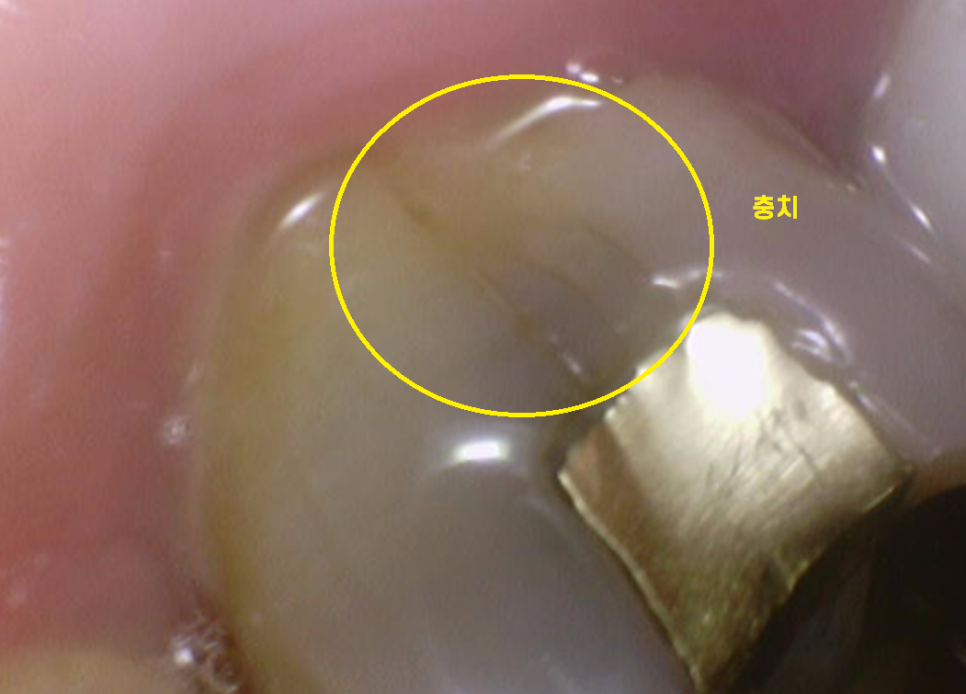 풍산동 치과 골드 인레이 치료했던 치아가 또 충치가 생김. 관련 이미지 7