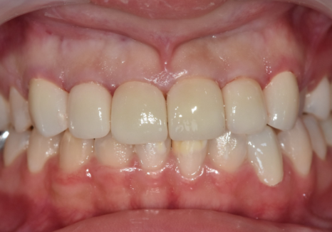 고덕역 치과 반점치 얼룩덜룩한 치아, 치료 실패 줄이는 5가지 기준 관련 이미지 9