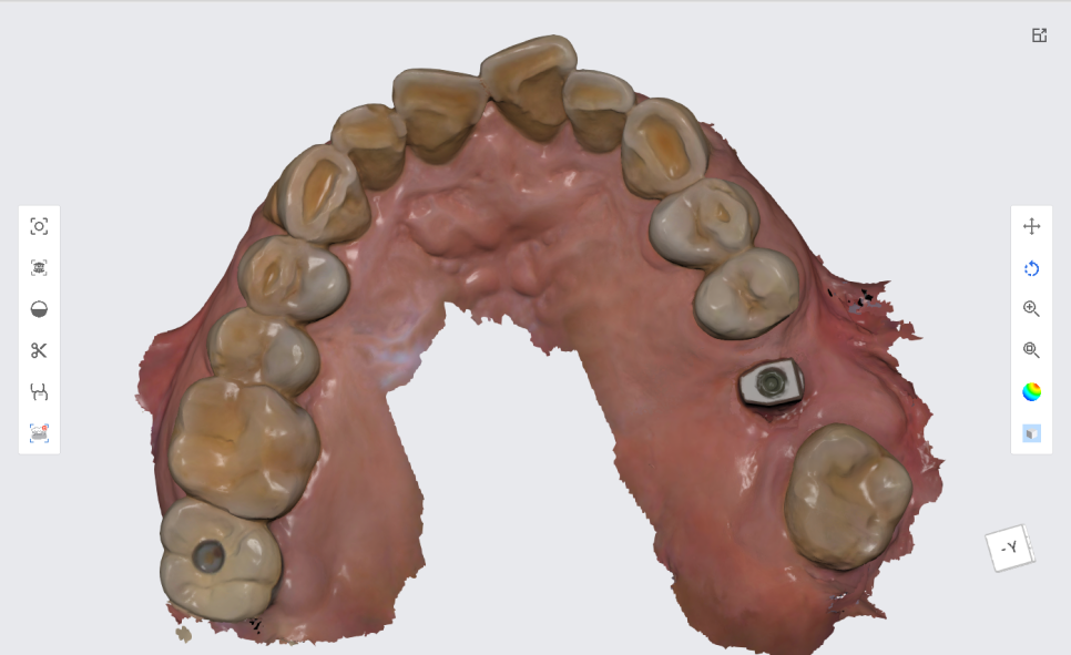 서울바르디치과 상하악 대구치 네비게이션 임플란트 치료증례 #4 관련 이미지 15
