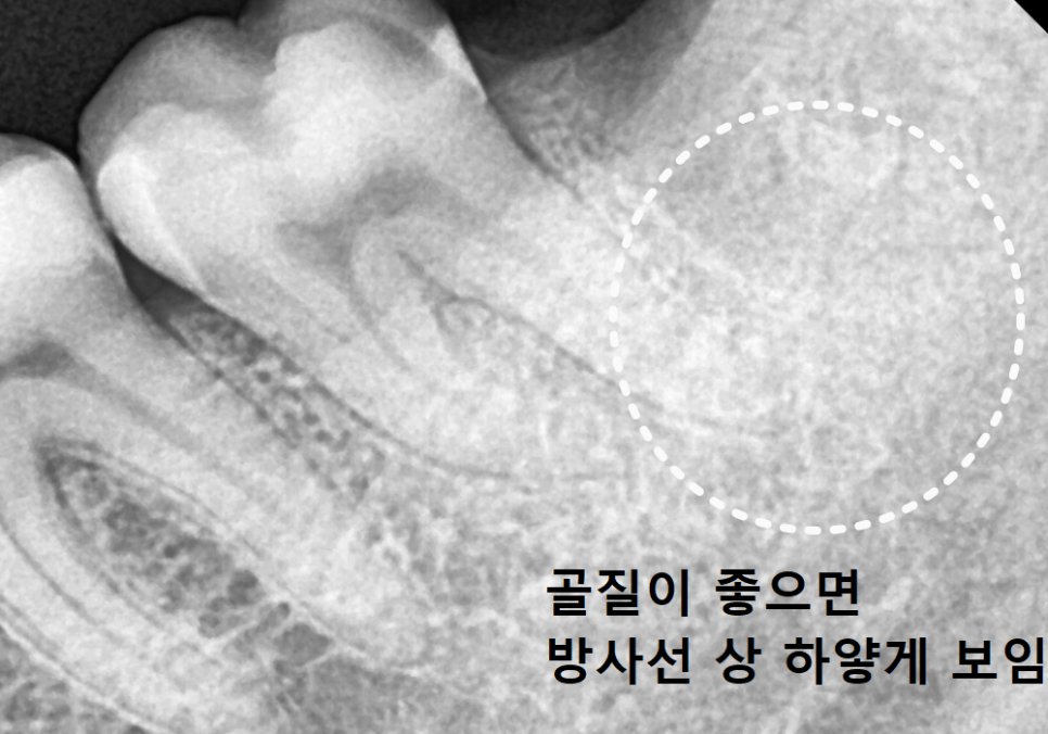 Sangil-dong Station Implant Visits: How Many Times Do You Actually Need to Go to the Dentist? image 1