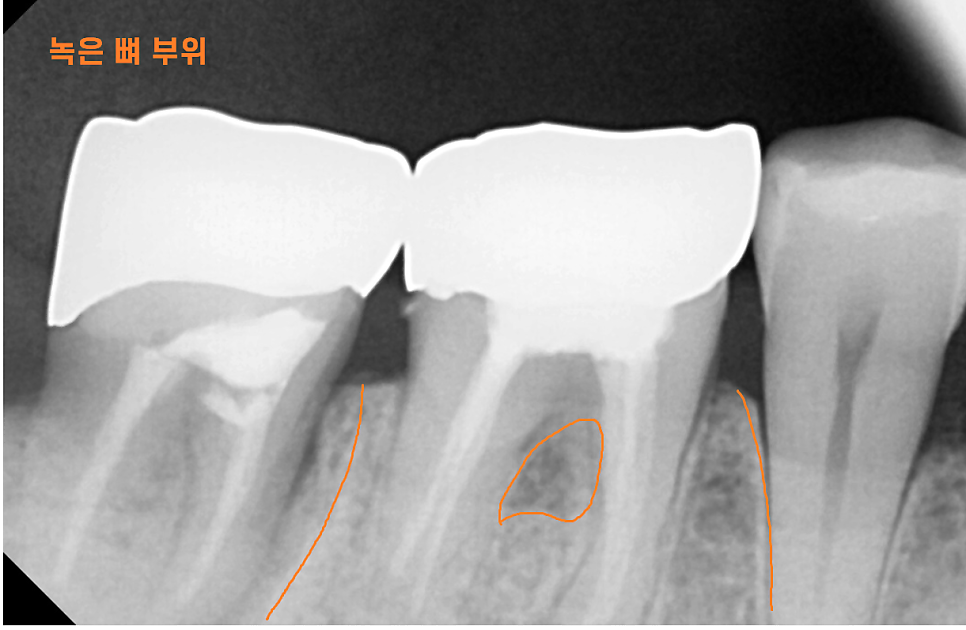 치아뿌리 염증 통증 유무 상관없이 치료를 받아야하는 이유 관련 이미지 3