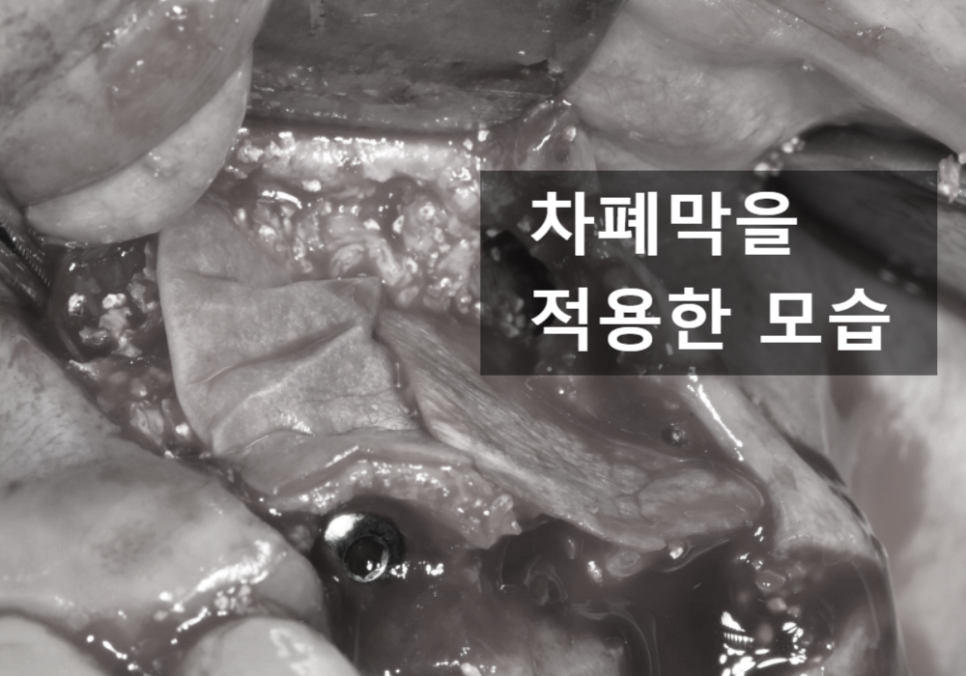 고덕동 임플란트, 튀어나온 앞니, 비용은 줄이고 자연스럽게 개선한 실제 사례 관련 이미지 8