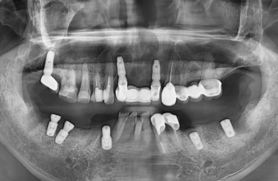 오래된 어금니 롱브릿지, 교체 타이밍을 놓치면 관련 이미지 14