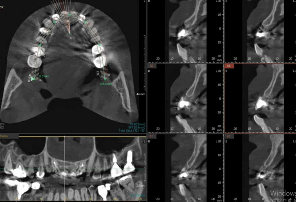 명일동 앞니 브릿지, 새로 교체 할 때 꼭 확인해 봐야 할 관련 이미지 5