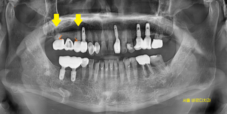 예전에 씌운 이 상악동 거상술 뼈이식 동반하여 임플란트 완료 관련 이미지 2