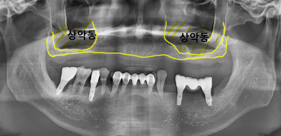 얇은 잇몸뼈, 임플란트 거부 당했다면? 상악동거상술로 해결할 수 있습니다. 관련 이미지 3