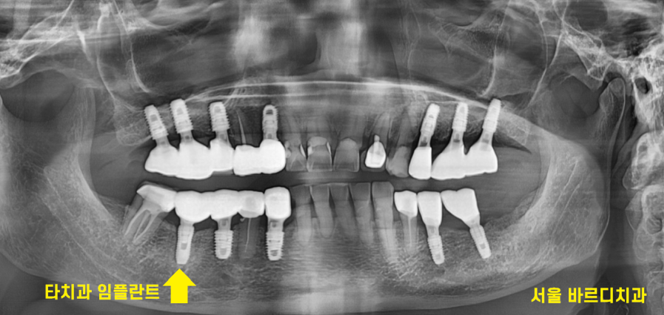 타치과 임플란트 as 수리 가능한 선동치과 관련 이미지 8