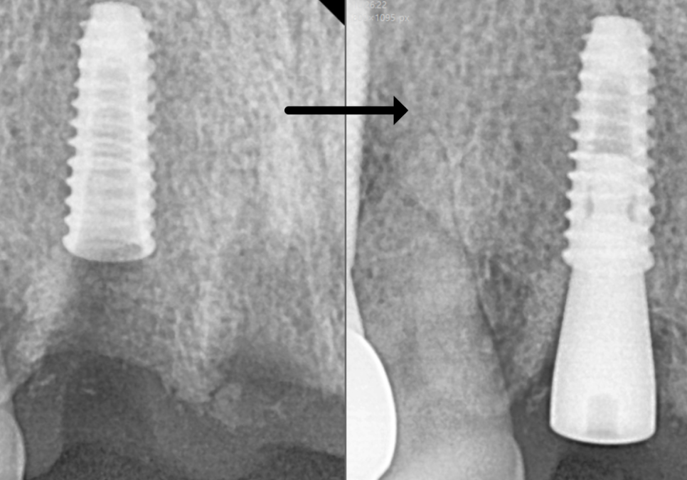 앞니 흔들림, 임플란트 치아보험 감액 기간 넘기려다 더 큰 손해 봅니다. 관련 이미지 9