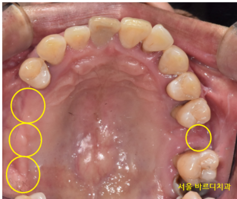 길동 치과 임플란트 뼈이식 후 흡연 상관 있을까? 관련 이미지 3