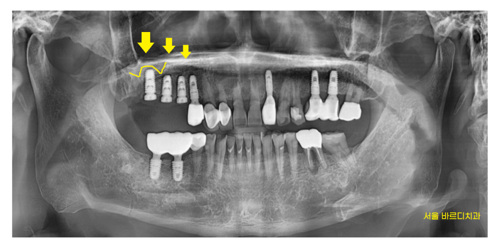예전에 씌운 이 상악동 거상술 뼈이식 동반하여 임플란트 완료 관련 이미지 5