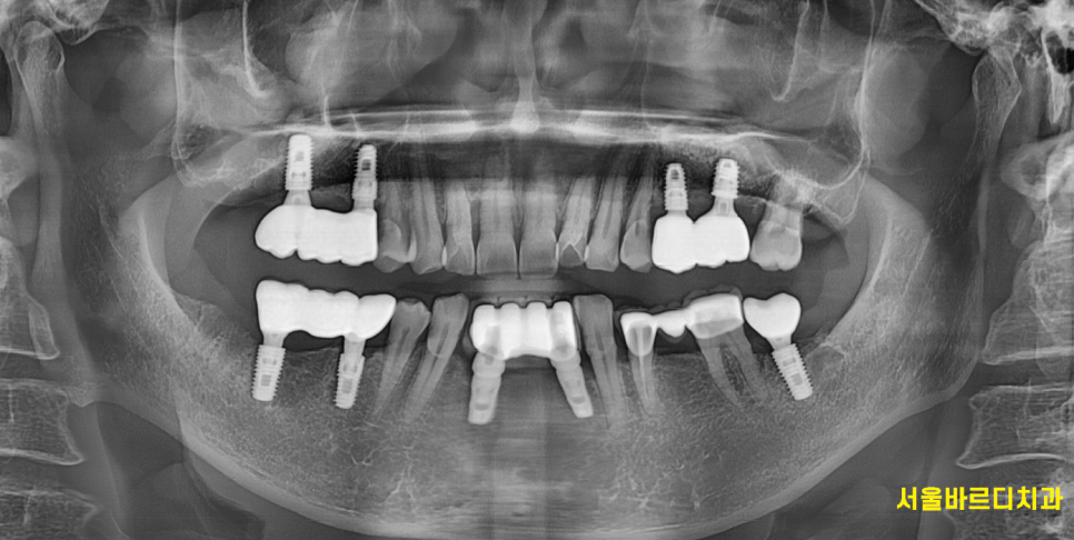 임플란트 시술 성공률, 얼마나 높을까? 처음 하시는 분들께 관련 이미지 5