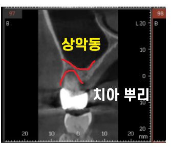 치아 쪼개짐으로 상악동 거상술 동반한 임플란트 수술 관련 이미지 5