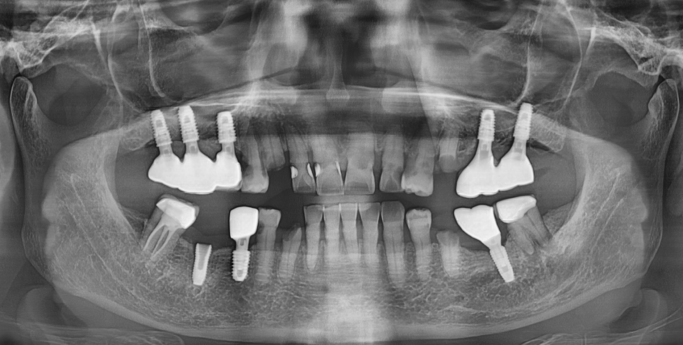 임플란트 사후관리 다른 병원 것도 수리 가능한 경우 정리해드립니다. 관련 이미지 2