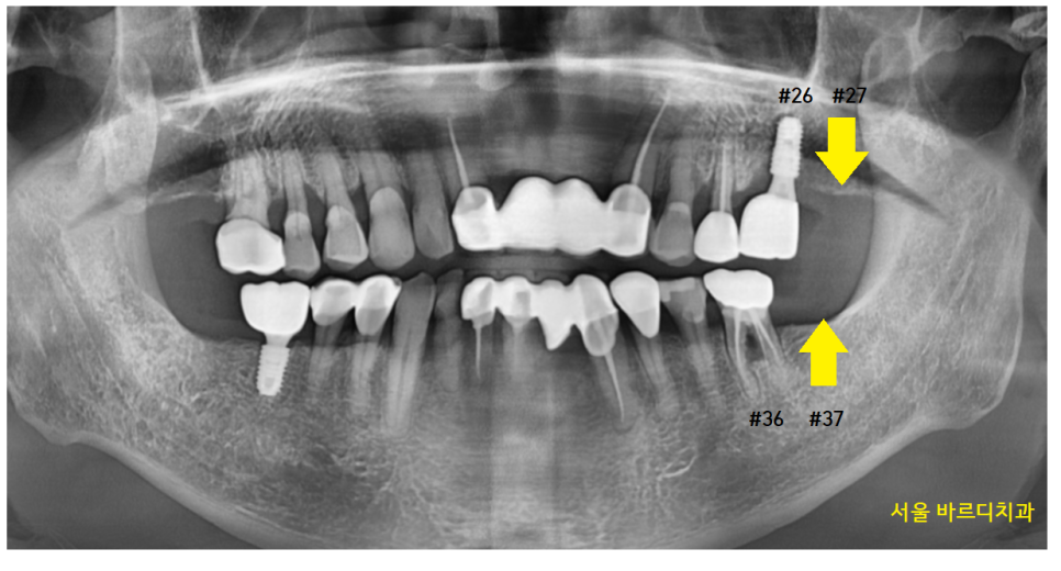 암사동 치과 임플란트 꼭 안 해도 되는 경우 궁금증 해결해 드려요 관련 이미지 14