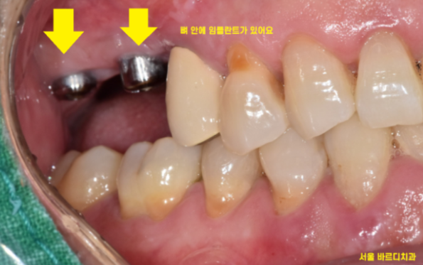 길동 치과 임플란트 2차 수술이요? 예전에 했잖아요 관련 이미지 2