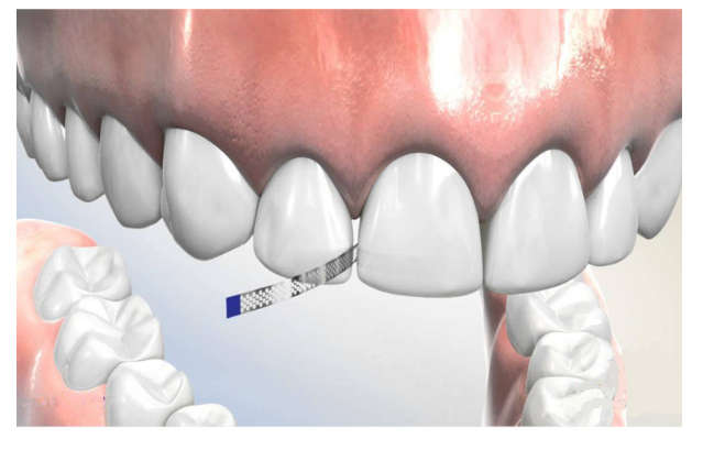 Are There Any Side Effects of Interproximal Reduction During Orthodontic Treatment? Click Here If You’re Concerned image 5