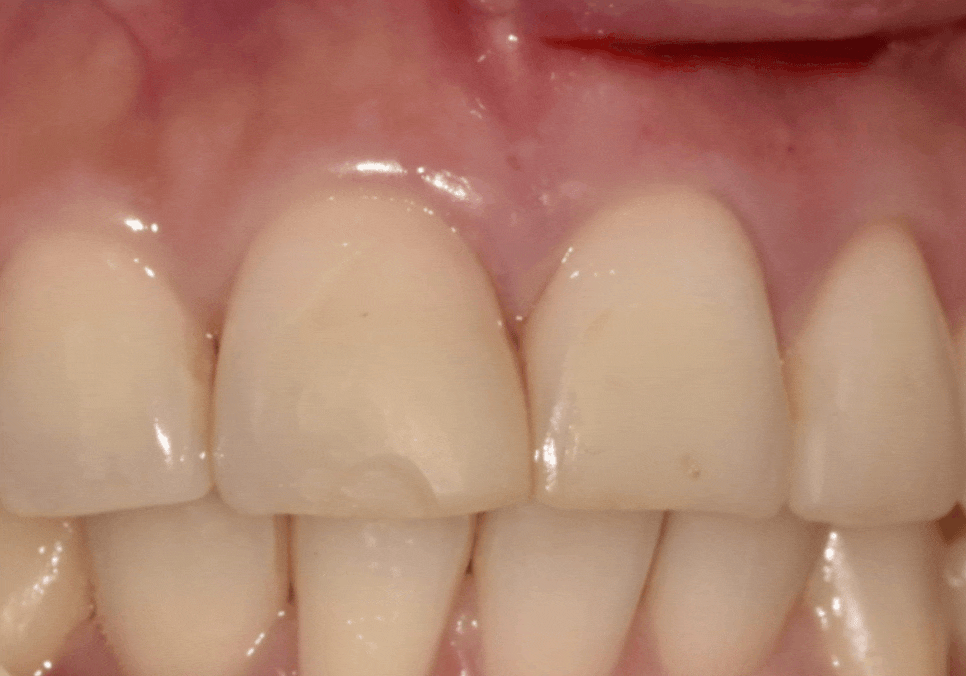 강일역 치과, 검게 보이는 앞니 레진 변색, 무조건 새로 해야 할까요? 관련 이미지 9