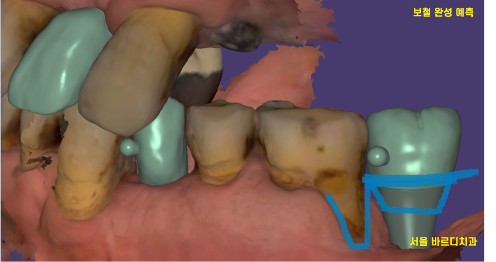 상일동역 근처 치과 타원 임플란트 제거 후 재식립 케이스 관련 이미지 9