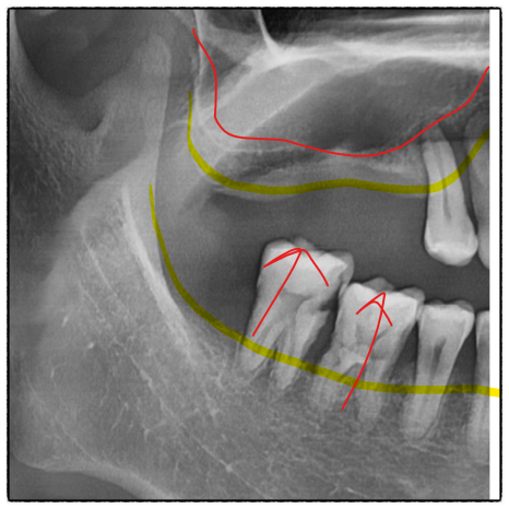 Gangdong-gu Dental Clinic: Are There Cases Where Implants Are Impossible? image 4