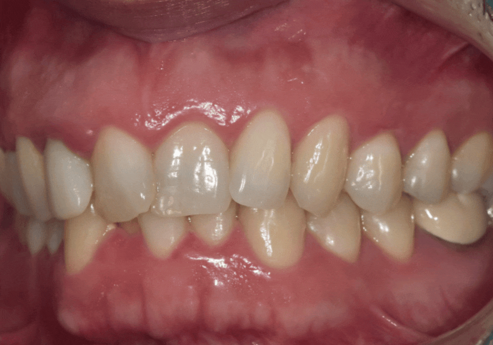 앞니 덧니, 교정은 싫고 시간은 없다면? 라미네이트로 해결한 사례 관련 이미지 5