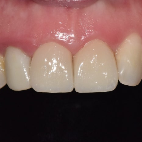 No-Prep Veneers: Do They Really Involve No Tooth Shaving? The 3 Questions Patients Ask Most image 4