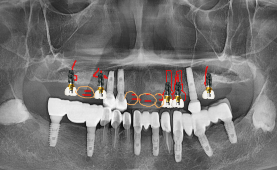 상일동 치과 부분 틀니에서 임플란트 바꿔서 사용하기 관련 이미지 4