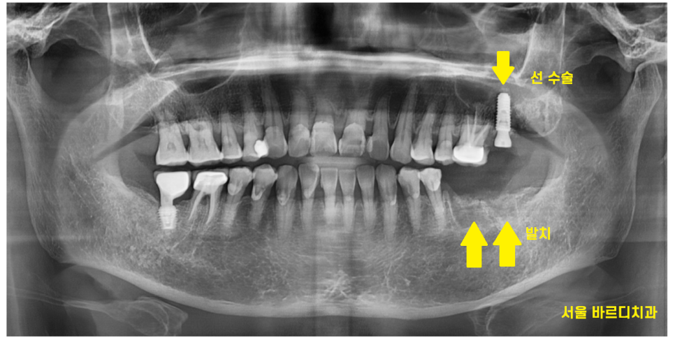고덕동 치과 어금니 흔들림과 통증 임플란트가 답일 때! 관련 이미지 7