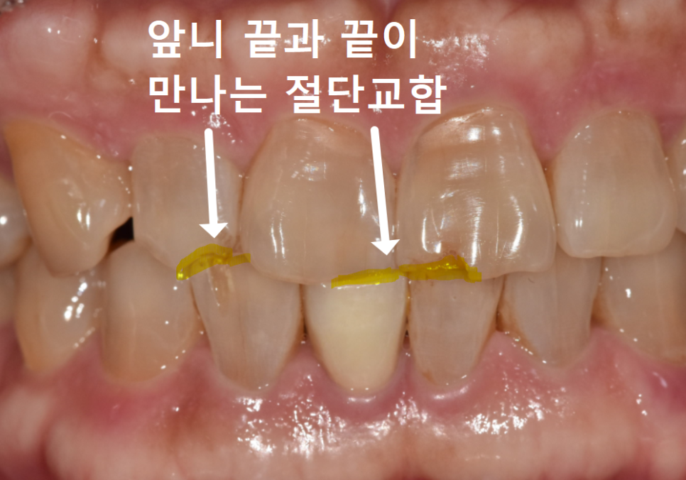 앞니 깨짐 치료 비용, 더이상 치과에 돈 낭비하기 싫다면? 깨지는 원인부터 알아야 합니다. 관련 이미지 6