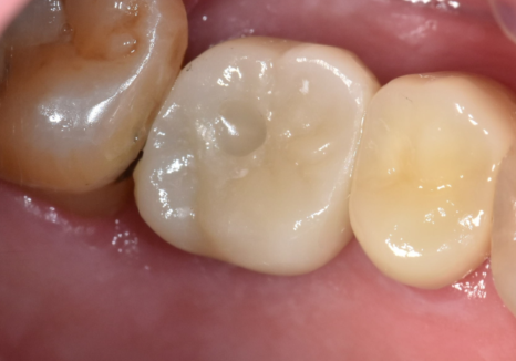 상일역 치과, 오래된 금니 빠짐, 같은 증상으로 내원했지만 전혀 다른 결과, 그 차이는? 관련 이미지 11